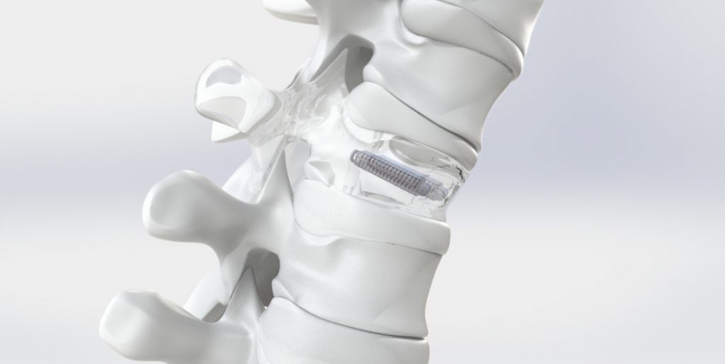 Klantverhalen Amber Implants Achtergrond